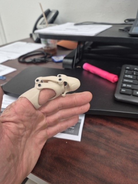 S.P. wearing the prosthetic at work, viewed from above at his desk